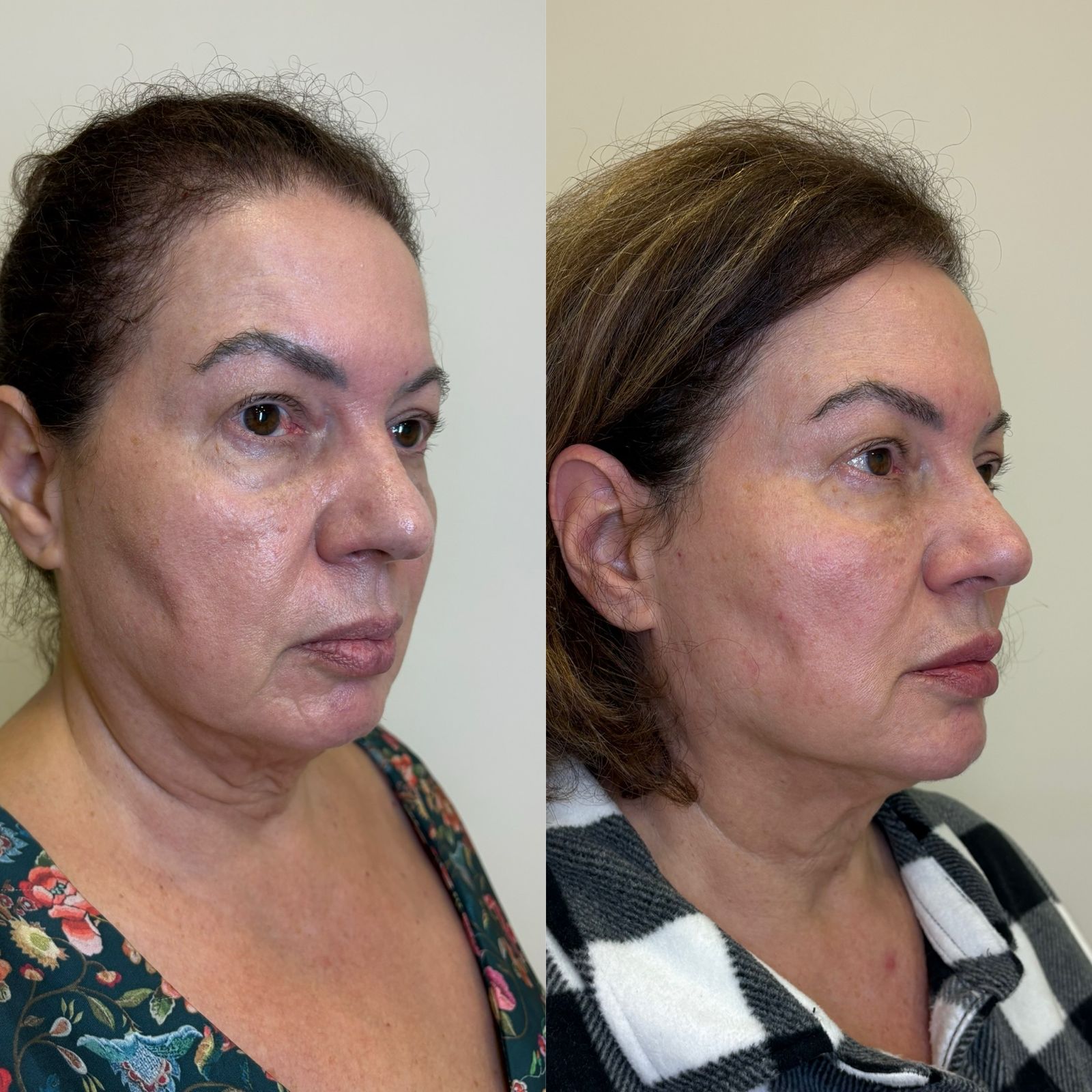Antes e depois