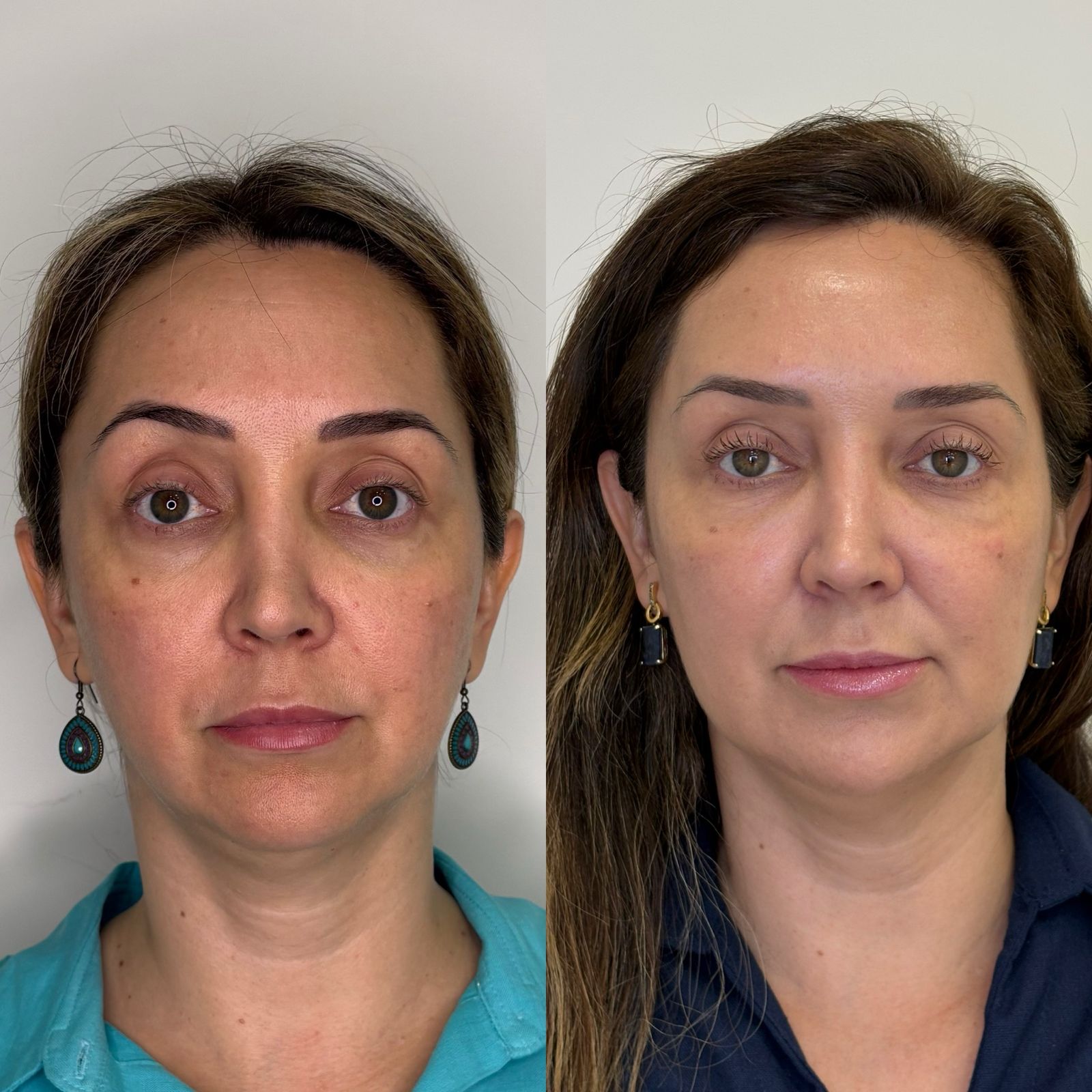 Antes e depois
